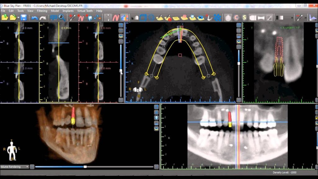 Crack para virtual plastic surgery software vpss