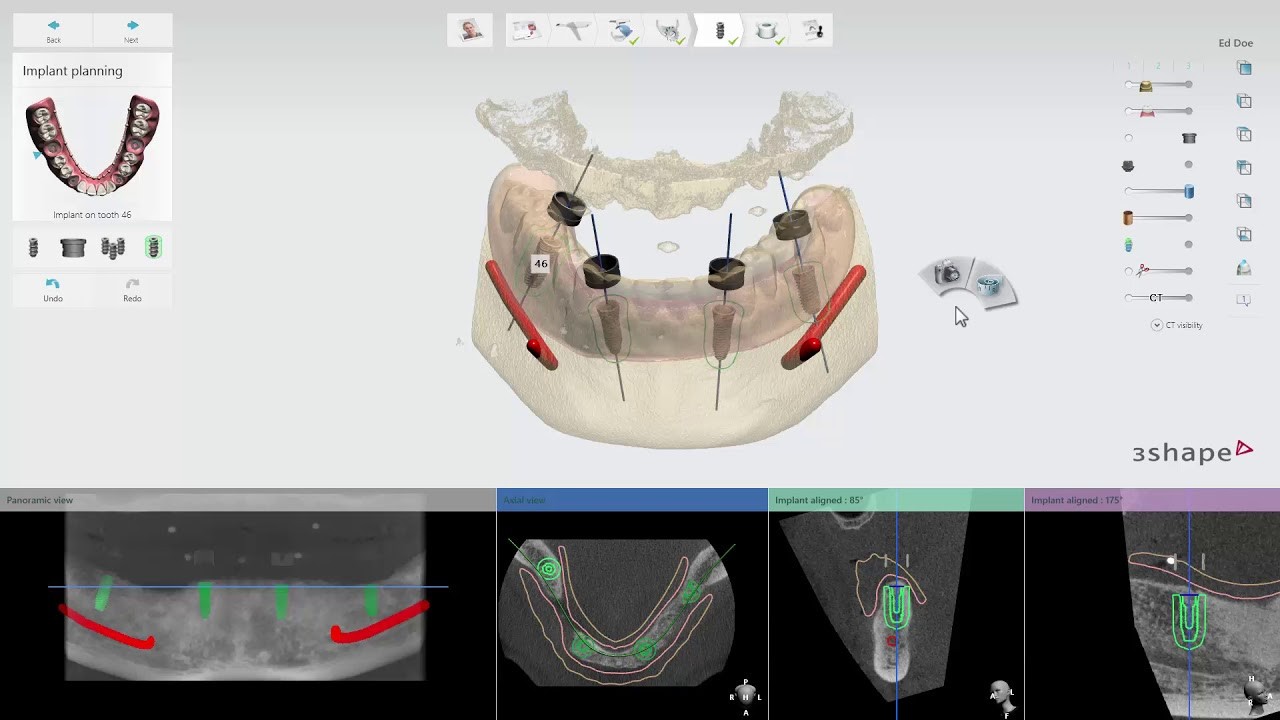 Имплант студио 3shape. 3shape модуль. 3dshape модуль для ортодонтии. Шаблон для имплантации зубов.