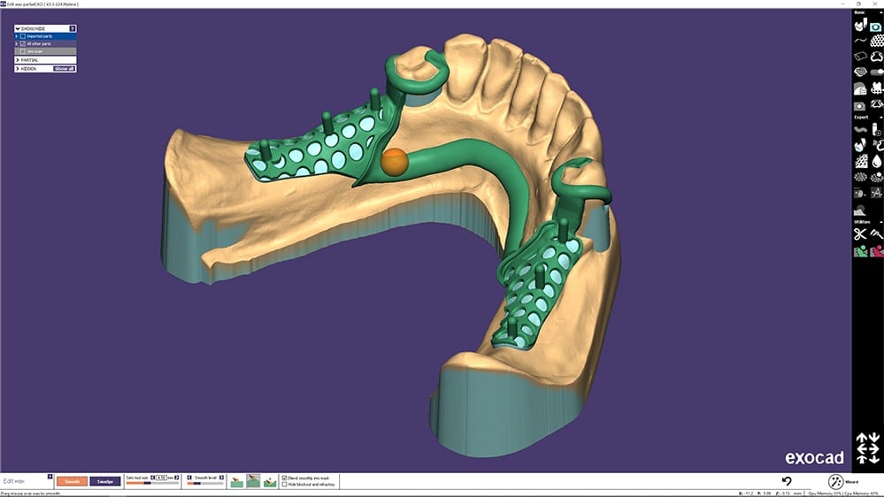 exocad_PartialCAD-Module_Edit-wax-lower