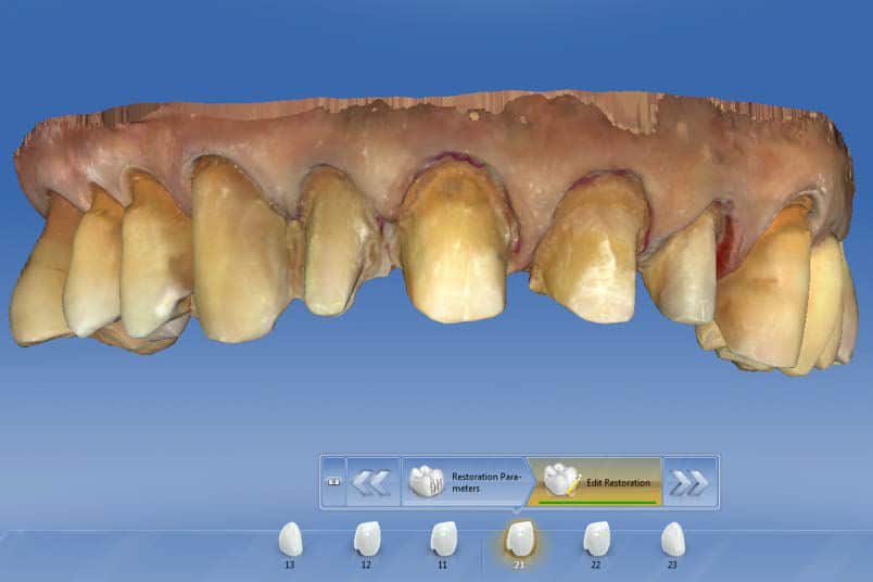 CEREC-AC-OMNICAM-_-PROSTOE-SKANIROVANIE-BEZ-ANTIBLIKOVOGO-SPREYA-8