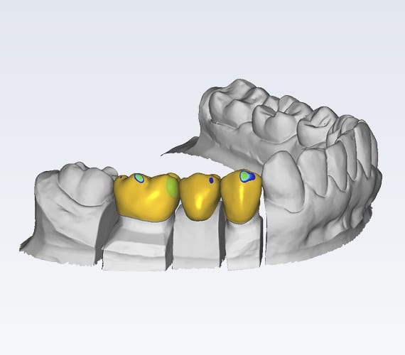 planmeca-plancad-premium-customisable-software