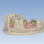 planmeca-plancad-premium-software-design-dental-prosthetics